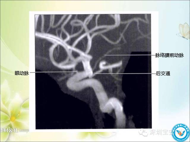 【PPT】颈内动脉颅内段影像解剖(附临床血管病例)