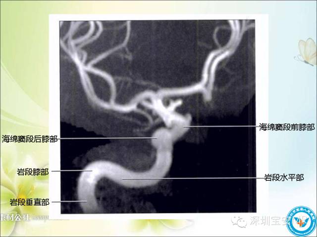 【PPT】颈内动脉颅内段影像解剖(附临床血管病例)