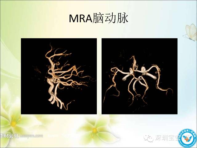 【PPT】颈内动脉颅内段影像解剖(附临床血管病例)