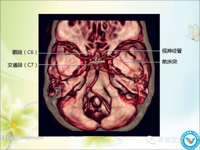 【PPT】颈内动脉颅内段影像解剖(附临床血管病例)