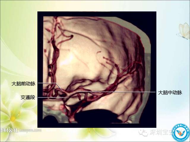 【PPT】颈内动脉颅内段影像解剖(附临床血管病例)