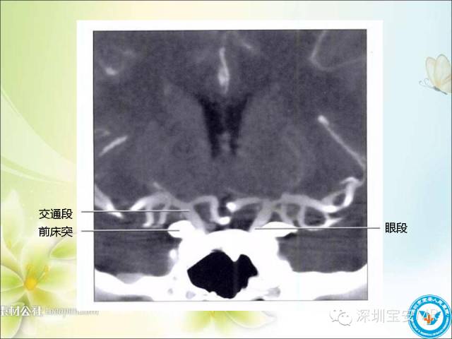 【PPT】颈内动脉颅内段影像解剖(附临床血管病例)