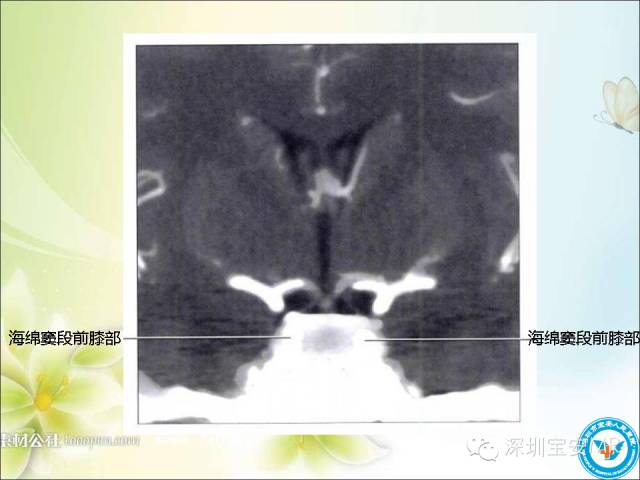 【PPT】颈内动脉颅内段影像解剖(附临床血管病例)