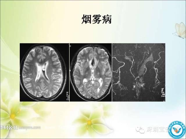 【PPT】颈内动脉颅内段影像解剖(附临床血管病例)