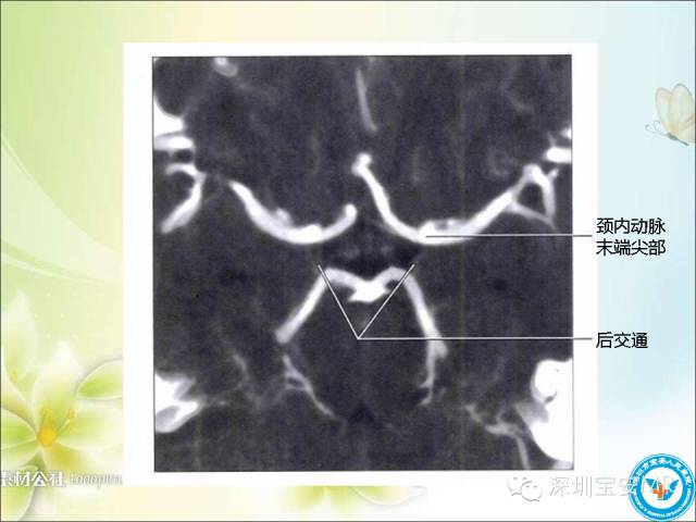 【PPT】颈内动脉颅内段影像解剖(附临床血管病例)
