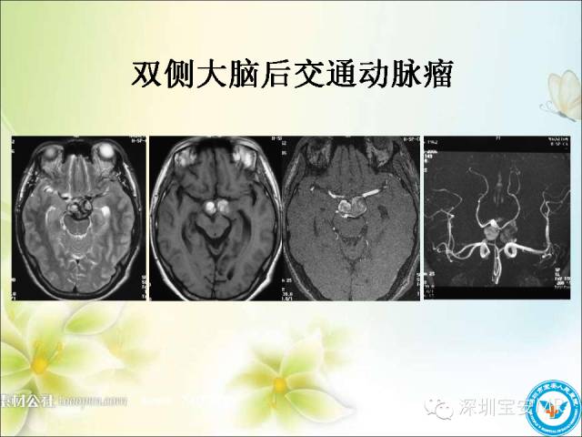 【PPT】颈内动脉颅内段影像解剖(附临床血管病例)