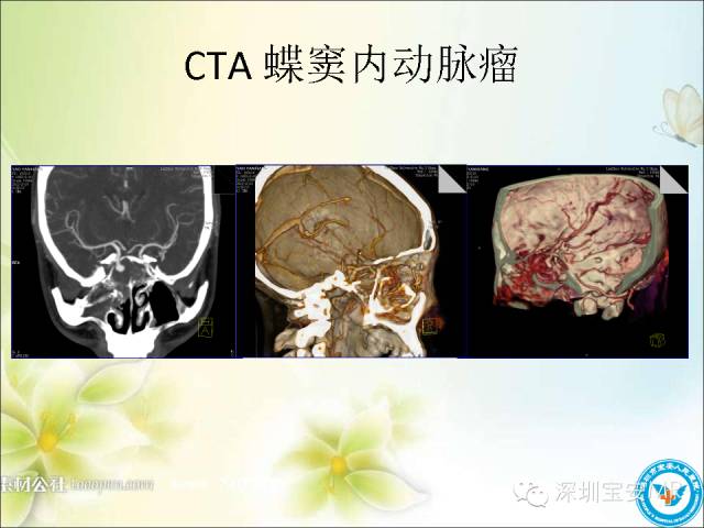 【PPT】颈内动脉颅内段影像解剖(附临床血管病例)