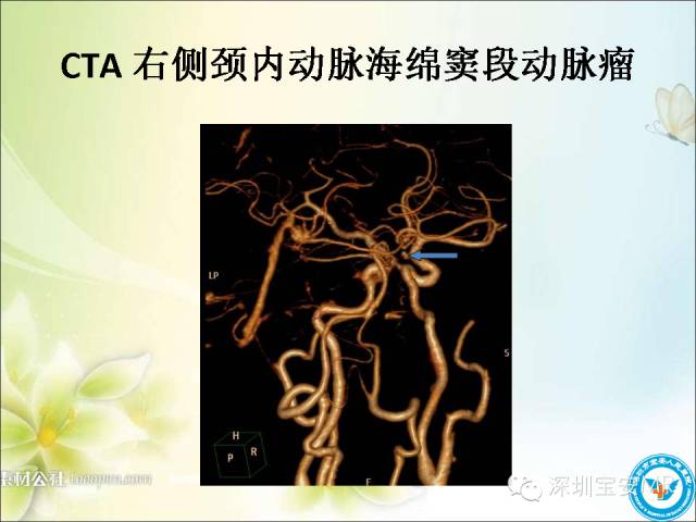 【PPT】颈内动脉颅内段影像解剖(附临床血管病例)