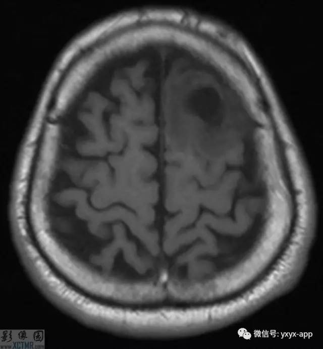 【病例】左侧额叶环形强化病变——囊虫病1例CT及MR