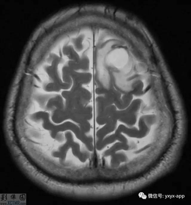 【病例】左侧额叶环形强化病变——囊虫病1例CT及MR