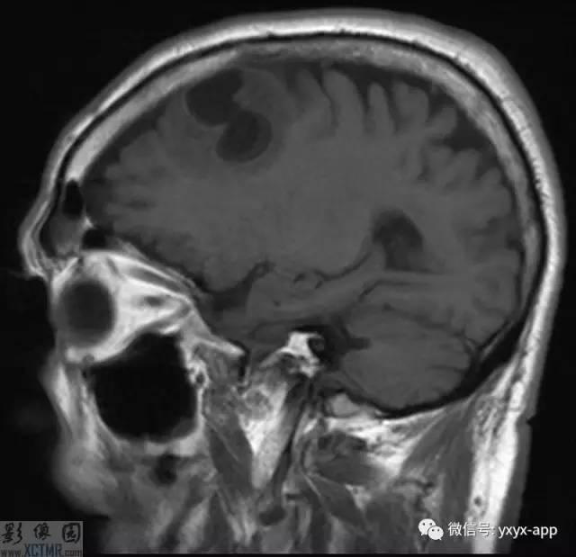 【病例】左侧额叶环形强化病变——囊虫病1例CT及MR