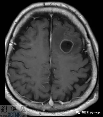 【病例】左侧额叶环形强化病变——囊虫病1例CT及MR
