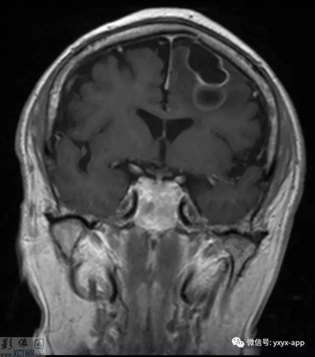【病例】左侧额叶环形强化病变——囊虫病1例CT及MR