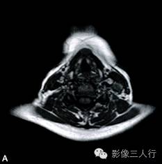 【病例】异位淋巴瘤性甲状腺肿1例MR影像表现分析 【病例】异位淋巴瘤性甲状腺肿1例MR影像表现分析