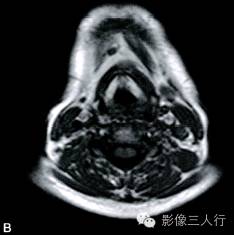 【病例】异位淋巴瘤性甲状腺肿1例MR影像表现分析 【病例】异位淋巴瘤性甲状腺肿1例MR影像表现分析