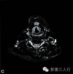 【病例】异位淋巴瘤性甲状腺肿1例MR影像表现分析 【病例】异位淋巴瘤性甲状腺肿1例MR影像表现分析