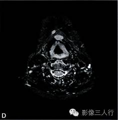 【病例】异位淋巴瘤性甲状腺肿1例MR影像表现分析 【病例】异位淋巴瘤性甲状腺肿1例MR影像表现分析