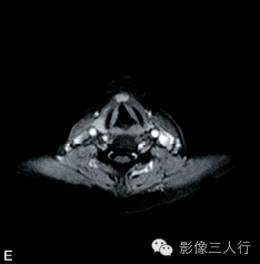 【病例】异位淋巴瘤性甲状腺肿1例MR影像表现分析 【病例】异位淋巴瘤性甲状腺肿1例MR影像表现分析