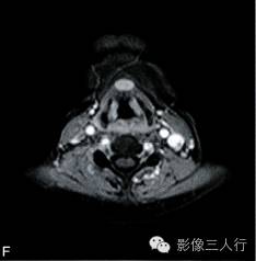 【病例】异位淋巴瘤性甲状腺肿1例MR影像表现分析 【病例】异位淋巴瘤性甲状腺肿1例MR影像表现分析