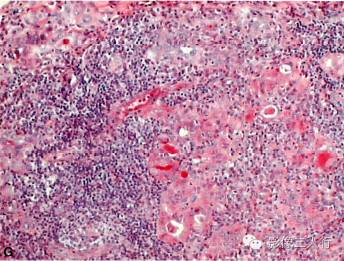 【病例】异位淋巴瘤性甲状腺肿1例MR影像表现分析 【病例】异位淋巴瘤性甲状腺肿1例MR影像表现分析