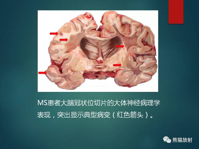 【PPT】脱髓鞘疾病、腔隙性脑梗死与血管周围间隙的鉴别诊断 【PPT】脱髓鞘疾病、腔隙性脑梗死与血管周围间隙的鉴别诊断