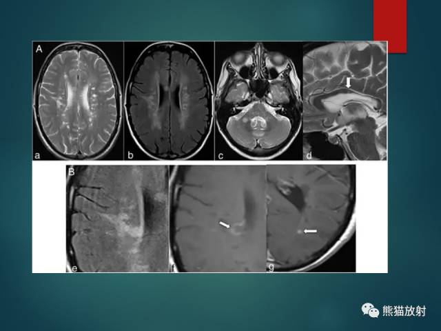 【PPT】脱髓鞘疾病、腔隙性脑梗死与血管周围间隙的鉴别诊断 【PPT】脱髓鞘疾病、腔隙性脑梗死与血管周围间隙的鉴别诊断