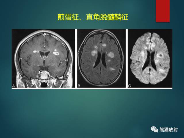 【PPT】脱髓鞘疾病、腔隙性脑梗死与血管周围间隙的鉴别诊断 【PPT】脱髓鞘疾病、腔隙性脑梗死与血管周围间隙的鉴别诊断