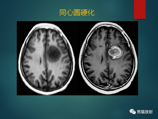 【PPT】脱髓鞘疾病、腔隙性脑梗死与血管周围间隙的鉴别诊断 【PPT】脱髓鞘疾病、腔隙性脑梗死与血管周围间隙的鉴别诊断
