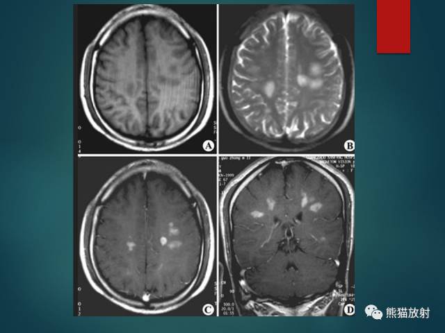 【PPT】脱髓鞘疾病、腔隙性脑梗死与血管周围间隙的鉴别诊断 【PPT】脱髓鞘疾病、腔隙性脑梗死与血管周围间隙的鉴别诊断