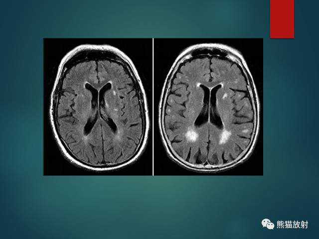 【PPT】脱髓鞘疾病、腔隙性脑梗死与血管周围间隙的鉴别诊断 【PPT】脱髓鞘疾病、腔隙性脑梗死与血管周围间隙的鉴别诊断