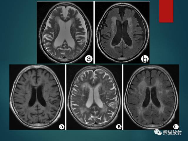 【PPT】脱髓鞘疾病、腔隙性脑梗死与血管周围间隙的鉴别诊断 【PPT】脱髓鞘疾病、腔隙性脑梗死与血管周围间隙的鉴别诊断