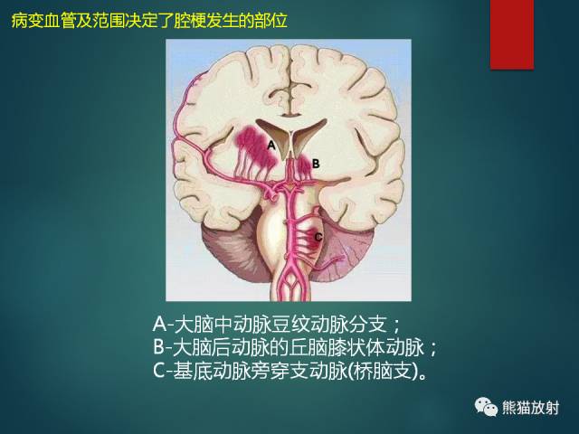 【PPT】脱髓鞘疾病、腔隙性脑梗死与血管周围间隙的鉴别诊断 【PPT】脱髓鞘疾病、腔隙性脑梗死与血管周围间隙的鉴别诊断