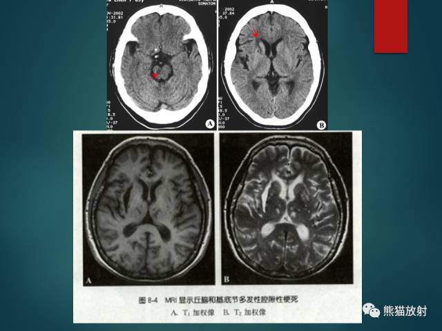 【PPT】脱髓鞘疾病、腔隙性脑梗死与血管周围间隙的鉴别诊断 【PPT】脱髓鞘疾病、腔隙性脑梗死与血管周围间隙的鉴别诊断