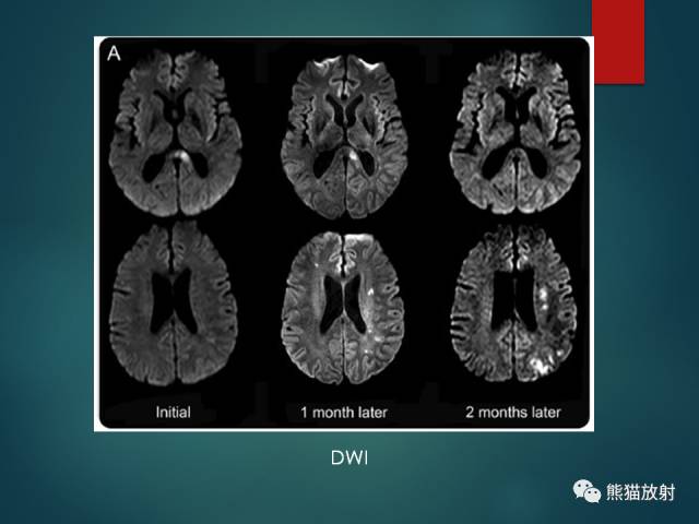 【PPT】脱髓鞘疾病、腔隙性脑梗死与血管周围间隙的鉴别诊断 【PPT】脱髓鞘疾病、腔隙性脑梗死与血管周围间隙的鉴别诊断