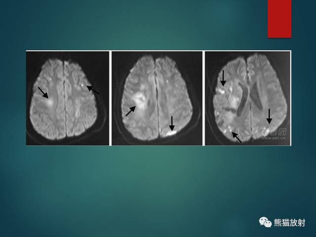 【PPT】脱髓鞘疾病、腔隙性脑梗死与血管周围间隙的鉴别诊断 【PPT】脱髓鞘疾病、腔隙性脑梗死与血管周围间隙的鉴别诊断