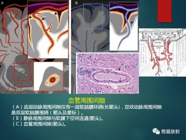【PPT】脱髓鞘疾病、腔隙性脑梗死与血管周围间隙的鉴别诊断 【PPT】脱髓鞘疾病、腔隙性脑梗死与血管周围间隙的鉴别诊断