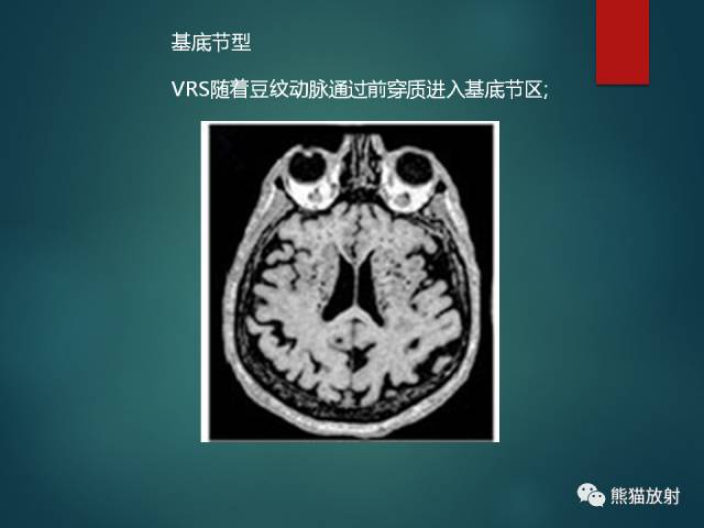 【PPT】脱髓鞘疾病、腔隙性脑梗死与血管周围间隙的鉴别诊断 【PPT】脱髓鞘疾病、腔隙性脑梗死与血管周围间隙的鉴别诊断