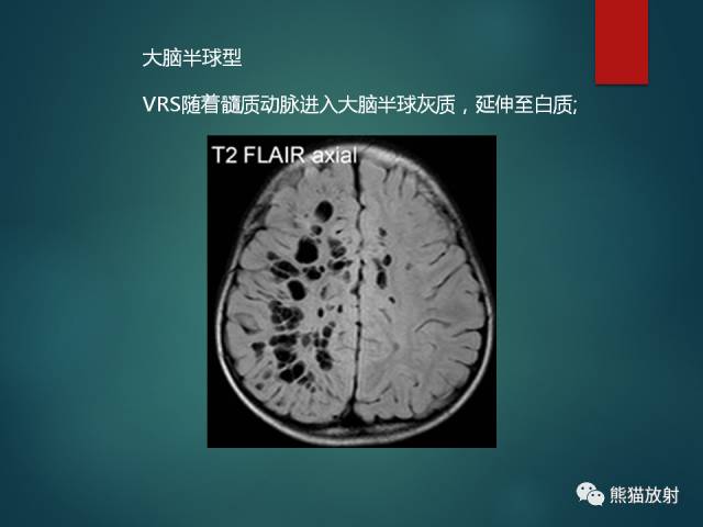 【PPT】脱髓鞘疾病、腔隙性脑梗死与血管周围间隙的鉴别诊断 【PPT】脱髓鞘疾病、腔隙性脑梗死与血管周围间隙的鉴别诊断