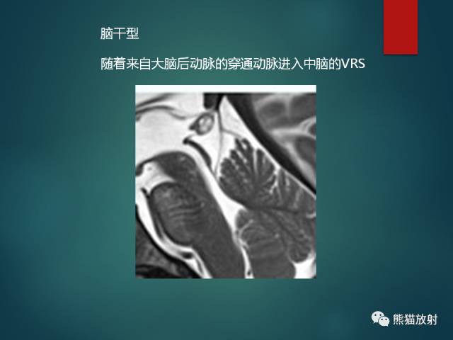 【PPT】脱髓鞘疾病、腔隙性脑梗死与血管周围间隙的鉴别诊断 【PPT】脱髓鞘疾病、腔隙性脑梗死与血管周围间隙的鉴别诊断