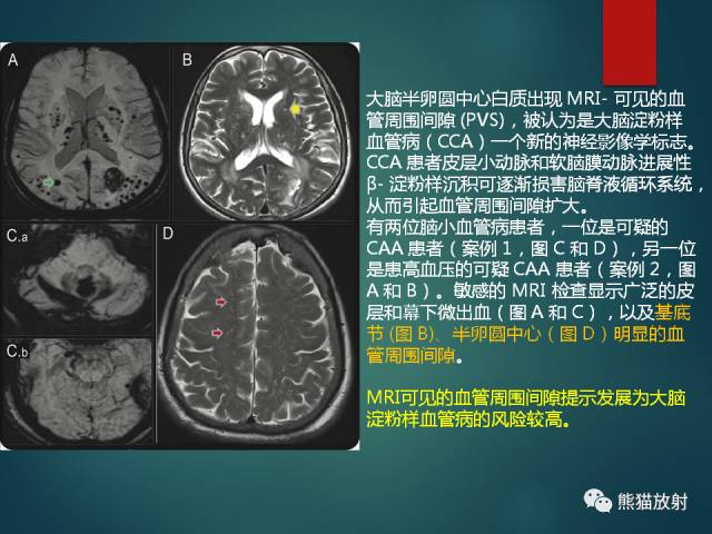 【PPT】脱髓鞘疾病、腔隙性脑梗死与血管周围间隙的鉴别诊断 【PPT】脱髓鞘疾病、腔隙性脑梗死与血管周围间隙的鉴别诊断