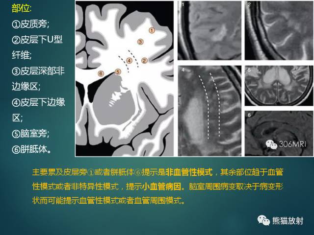 【PPT】脱髓鞘疾病、腔隙性脑梗死与血管周围间隙的鉴别诊断 【PPT】脱髓鞘疾病、腔隙性脑梗死与血管周围间隙的鉴别诊断