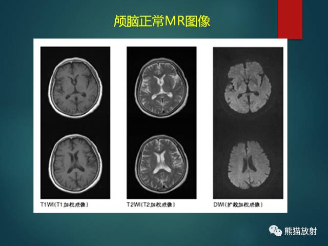 【PPT】脱髓鞘疾病、腔隙性脑梗死与血管周围间隙的鉴别诊断 【PPT】脱髓鞘疾病、腔隙性脑梗死与血管周围间隙的鉴别诊断
