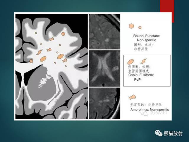 【PPT】脱髓鞘疾病、腔隙性脑梗死与血管周围间隙的鉴别诊断 【PPT】脱髓鞘疾病、腔隙性脑梗死与血管周围间隙的鉴别诊断