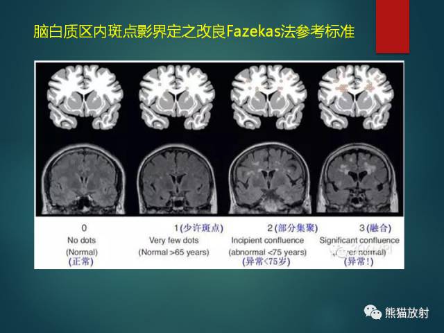 【PPT】脱髓鞘疾病、腔隙性脑梗死与血管周围间隙的鉴别诊断 【PPT】脱髓鞘疾病、腔隙性脑梗死与血管周围间隙的鉴别诊断
