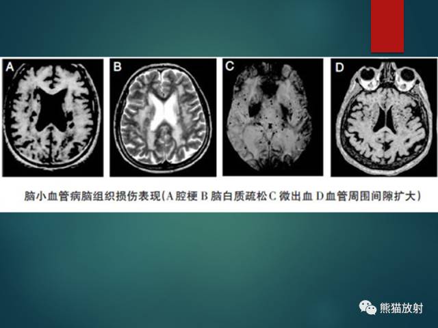 【PPT】脱髓鞘疾病、腔隙性脑梗死与血管周围间隙的鉴别诊断 【PPT】脱髓鞘疾病、腔隙性脑梗死与血管周围间隙的鉴别诊断