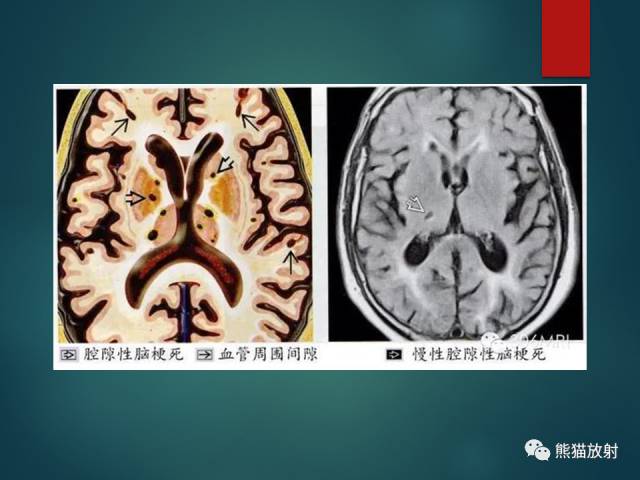 【PPT】脱髓鞘疾病、腔隙性脑梗死与血管周围间隙的鉴别诊断 【PPT】脱髓鞘疾病、腔隙性脑梗死与血管周围间隙的鉴别诊断