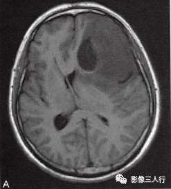 【病例】胶质母细胞瘤1例MR影像表现