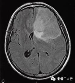 【病例】胶质母细胞瘤1例MR影像表现