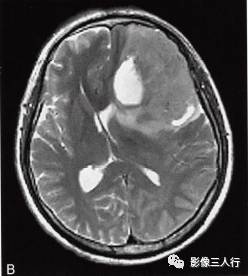 【病例】胶质母细胞瘤1例MR影像表现