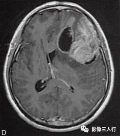 【病例】胶质母细胞瘤1例MR影像表现